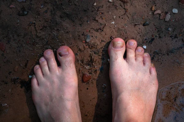 Detailní Záběr Nohou Muže Který Stojí Zemi Plísňové Onemocnění Prstech — Stock fotografie