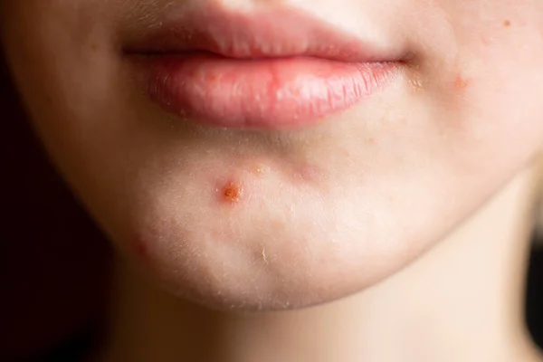 少女下巴上的粉刺 皮肤问题 青春期 后续行动 — 图库照片