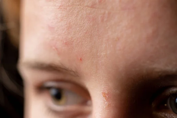 少女额头上的粉刺皮肤的近视与炎症 青春期 青春期 后续行动 — 图库照片