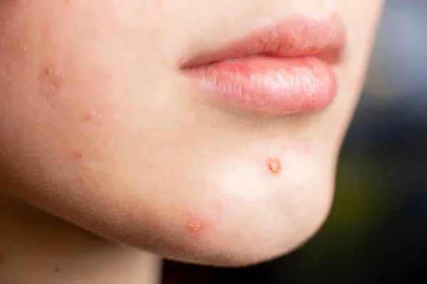 Finnar Ansiktet Oigenkännlig Tonåring Flicka Svart Bakgrund Dermatologi Övergångsålder — Stockfoto
