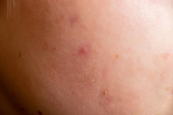 有特写的大粉刺的皮肤 皮肤病 皮肤病 — 图库照片