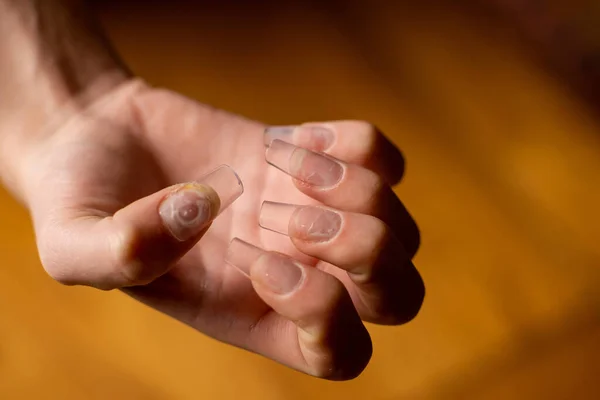 Dedos Con Mala Manicura Clavos Falsos —  Fotos de Stock