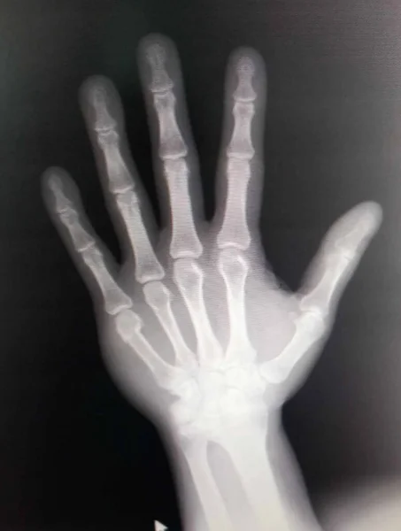 X-rayed human hand. X-ray of hand bones.