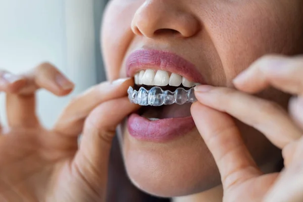 Close Woman Wearing Orthodontic Silicone Trainer Invisible Braces Aligner — Stock Photo, Image