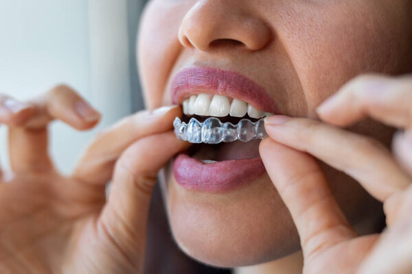 Close-up of woman wearing orthodontic silicone trainer. Invisible braces aligner.