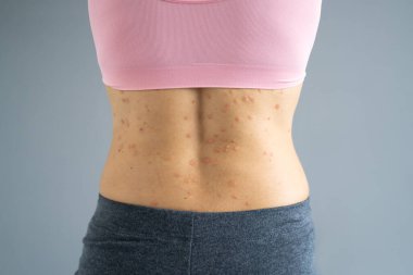 Otoimmün Sedef Hastalıklı Vücut Cildi. Tıbbi Hastalık