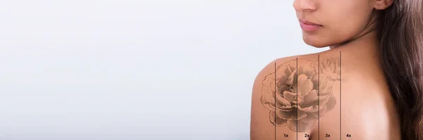 Laser Tatuering Borttagning Före Efter Isolerad Kvinna — Stockfoto