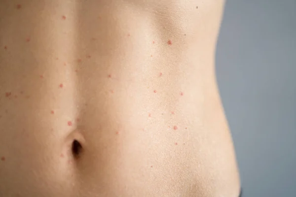 赤いアレルギーの噴火と女性の体の皮膚の発疹 — ストック写真