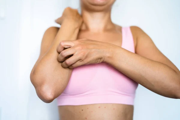 Škrábání Svědivé Kůže Citlivý Ekzém Vyrážka Dermatitida — Stock fotografie