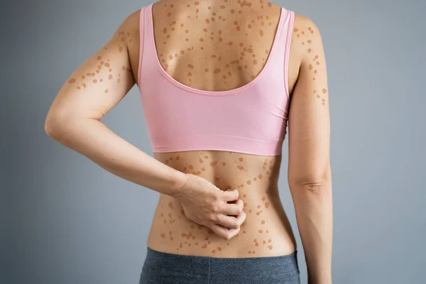 Skin Rash And Itchy Back Acne. Dry Eczema Allergy