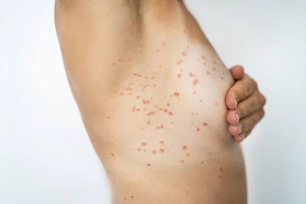 Erupção Cutânea Corpo Mulher Com Alergia Vermelha — Fotografia de Stock