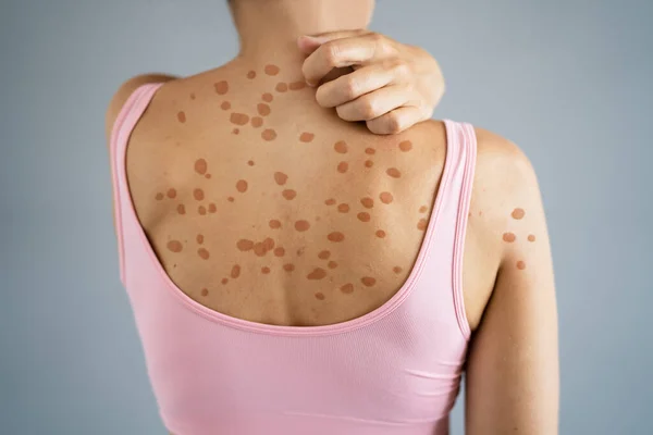 Εξάνθημα Δέρματος Και Φαγούρα Στην Πλάτη Ξηρό Έκζεμα Αλλεργία — Φωτογραφία Αρχείου