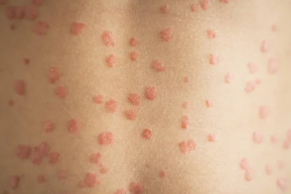 Body Skin With Psoriasis Autoimmune Disease. Medical Illness