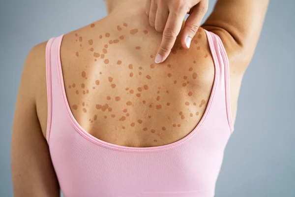 Woman Body Skin Rash Red Allergy Eruption — Stock Photo, Image