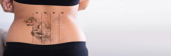 Laserové Odstranění Tetování Před Izolovaná Žena — Stock fotografie