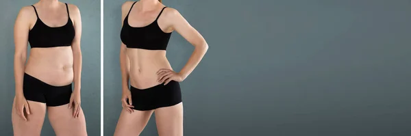 Fettabsaugung Vorher Und Nachher Mädchen Mit Gewichtsverlust — Stockfoto
