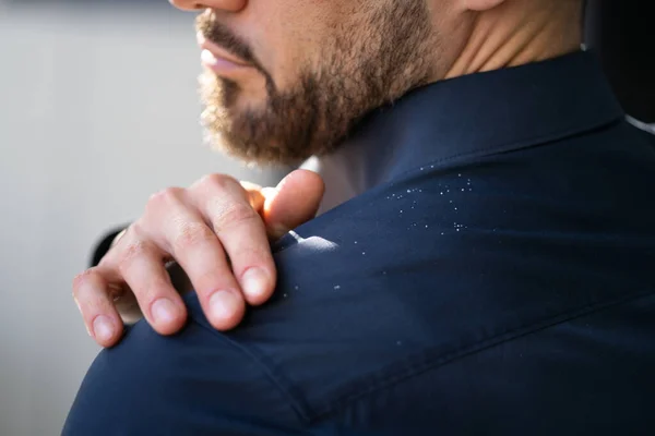 Man Dandruff Suit Shoulder Dirty Clothes — Stok Foto