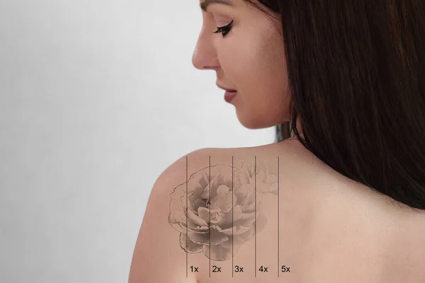 Laser Tattoo Removal On Woman\'s Shoulder. Medical Treatment