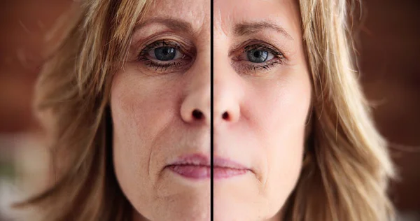 Woman Before After Skin Lift Dermatology Injection