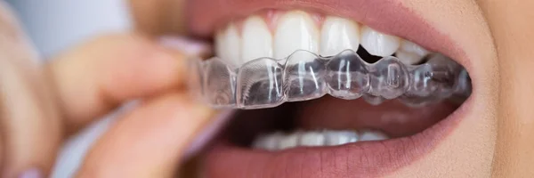 Chiaro Allineatore Guardia Notturna Dentale Denti — Foto Stock