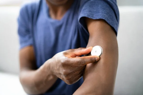 Närbild Man Testa Glukos Nivå Med Kontinuerlig Glukos Bildskärm Armen — Stockfoto