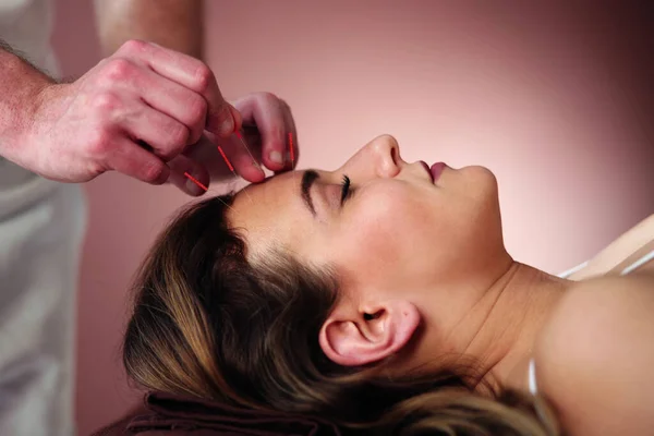 Woman Receiving Acupuncture Treatment Beauty Spa — Stock Photo, Image