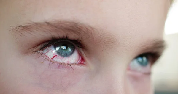 Irritation Allergie Des Vaisseaux Oculaires Rouges Macro Fermer — Photo