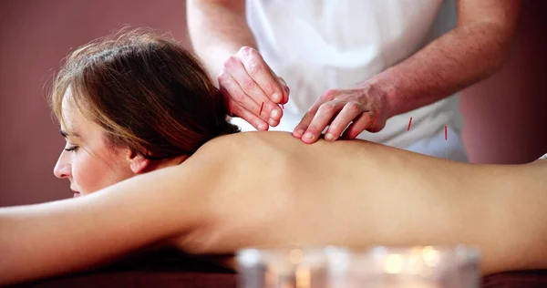 Dry Needle Acupuncture Treatment. Female Medical Spa Therapy
