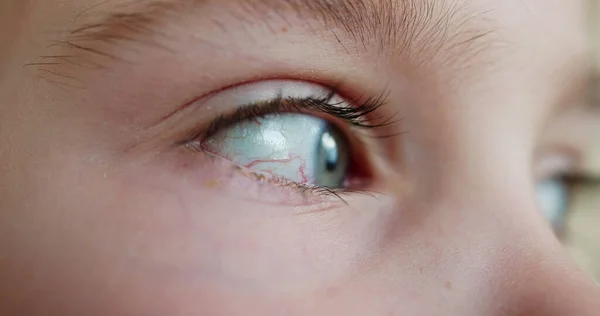 Red Eye Vessels Irritation Allergy Macro Close — Stock Photo, Image
