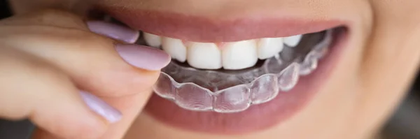 Καθαρίστε Ευθυγράμμιση Οδοντιατρική Νυχτερινή Φρουρά — Φωτογραφία Αρχείου