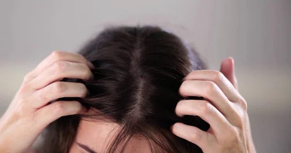 Behandlung Von Haarschuppen Und Juckender Kopfhaut — Stockfoto