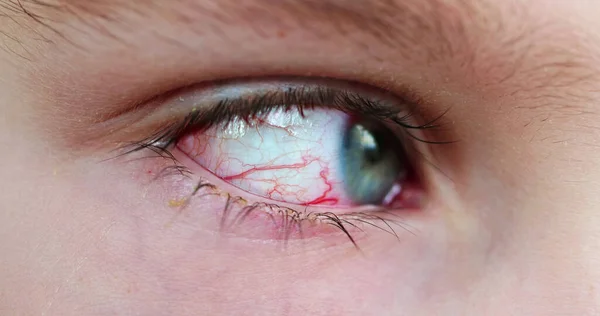 Vasos Olhos Vermelhos Irritação Alergia Macro Close — Fotografia de Stock