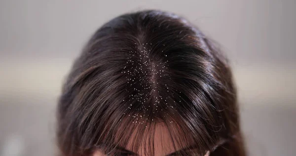 Itchy Head Scalp Hair Dandruff Problem — Stock Photo, Image