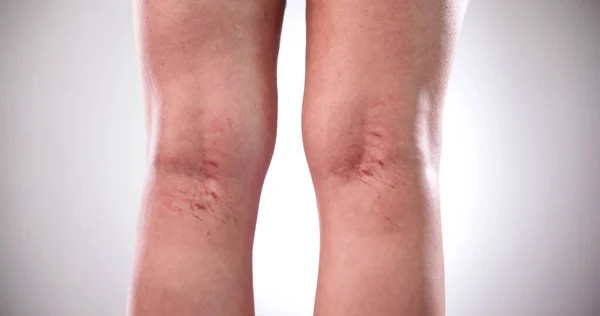 Behandlung Von Krampfadern Beinvenen Schmerzen Oberschenkel — Stockfoto