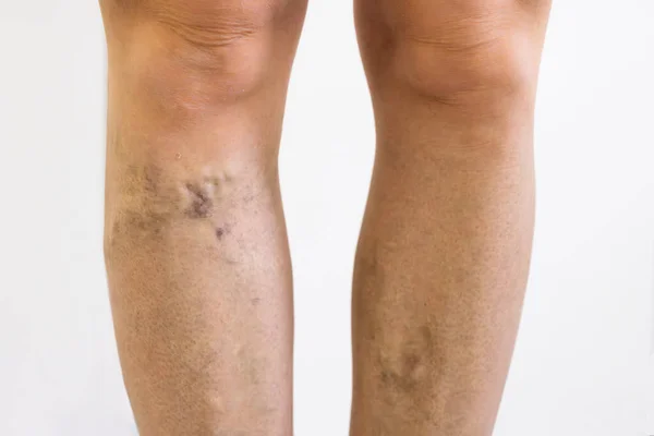 Selülit Ltihaplanma Sonrası Bacak Tedavisi Kapanmasından Önce — Stok fotoğraf