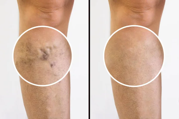 Tıbbi Tedavi Öncesi Sonrası Varis Kılcal Damarları Olan Insan Bacağı — Stok fotoğraf