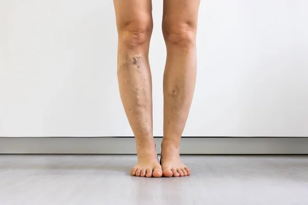 Vor Der Behandlung Von Cellulite Entzündungen Beine Nahaufnahme — Stockfoto