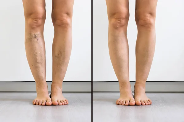 Person Leg Varicose Veins Capillaries Medical Treatment — Stock Photo, Image