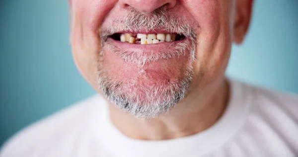 Kayıp Dişinle Gülümse Kırık Diş Yokluğu — Stok fotoğraf