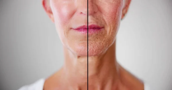 Vrouw Voor Face Lift Therapie Injectie — Stockfoto