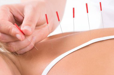 Closeup of hand performing acupuncture therapy on customer's back at salon clipart