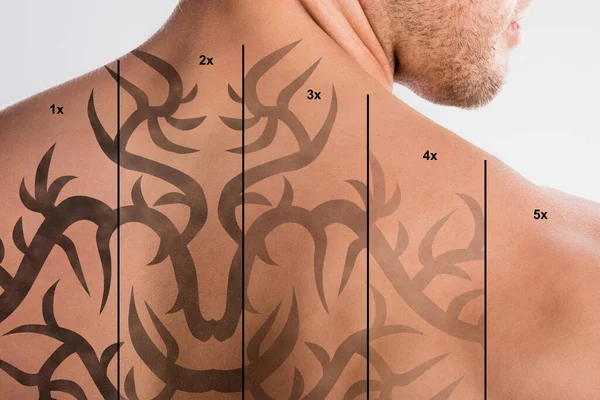 Laser Tattoo Removal On Shirtless Man's Back Against Grey Background