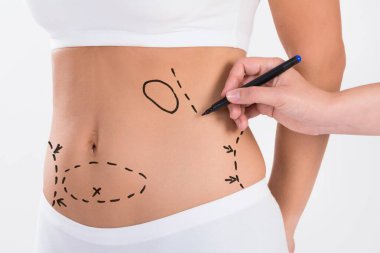 Kadın liposuction cerrahi için beyaz arka plan üzerinde hazırlanıyor bir cerrah her bir resim kırpılmış