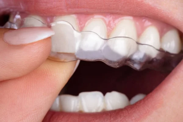 Close Woman Hand Menempatkan Transparent Aligner Teeth — Stok Foto