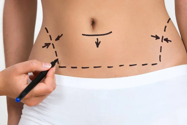 Líneas Dibujo Mano Persona Abdomen Pierna Mujer Para Corrección Celulitis — Foto de Stock