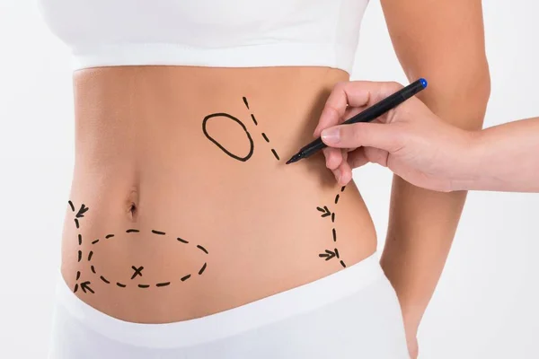 Liposuction