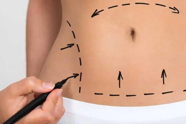stock image Person Hand Drawing Lines On A Woman's Abdomen As Marks For Abdominal Cellulite Correction