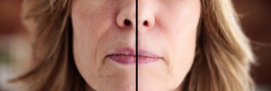 Kırışıklık giderici yüz bakımı sonrası cilt gerdirme.