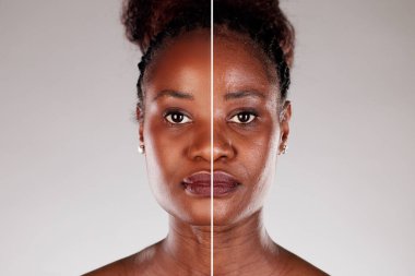 Genç Afrikalı Amerikalı Kadın Cildinin Dönüşümü: Kırışıklıklar İçin Laser Yüz Bakımı Öncesi ve Sonrası.