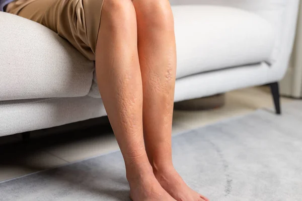 Woman Suffer Legs Injury — Stock Photo, Image